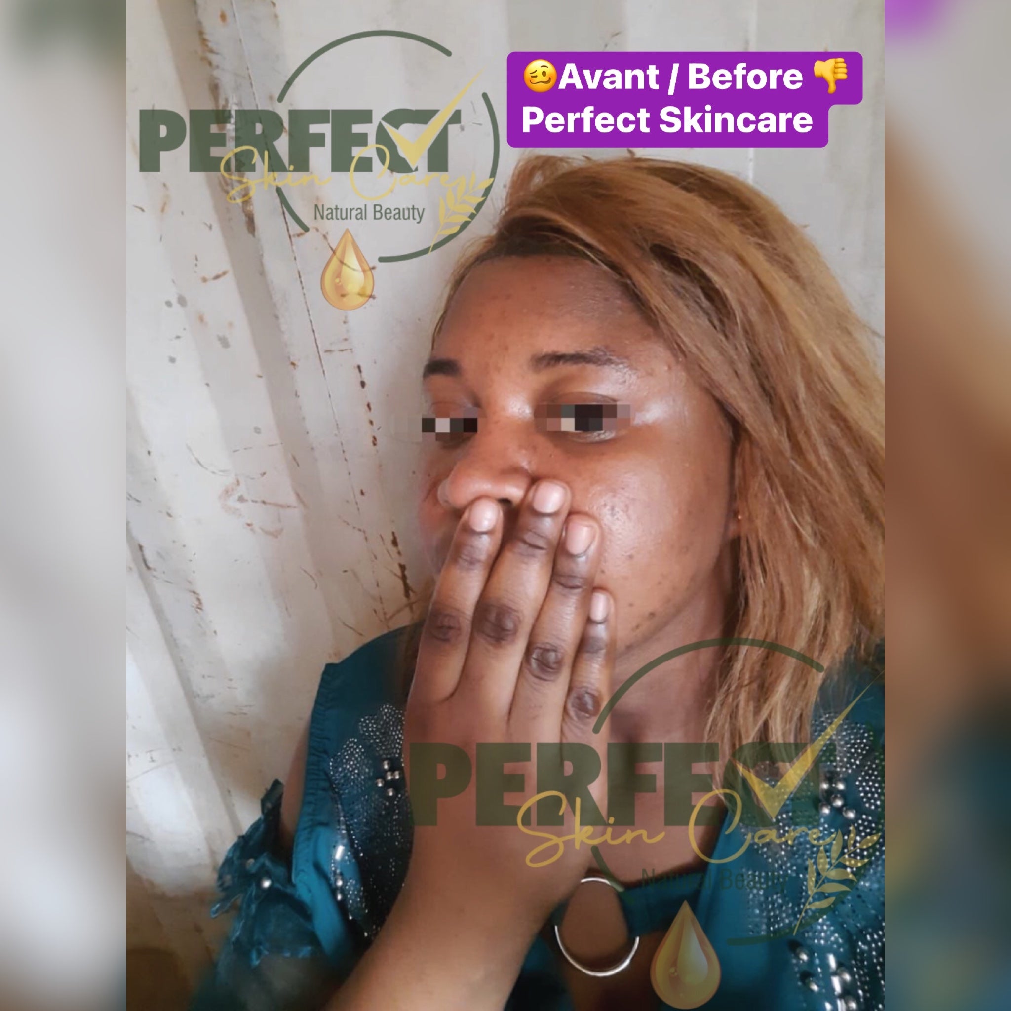 Retour: Gamme réparatrice et éclaircissante (vissage avec taches et boutons) + Kit Quintos